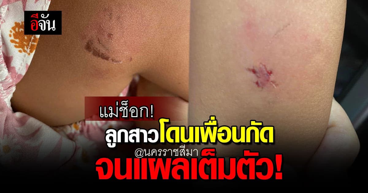 แม่โพสต์หาทางช่วยลูก หลังถูกเพื่อนในโรงเรียน กัดจนเป็นแผลทั้งตัว