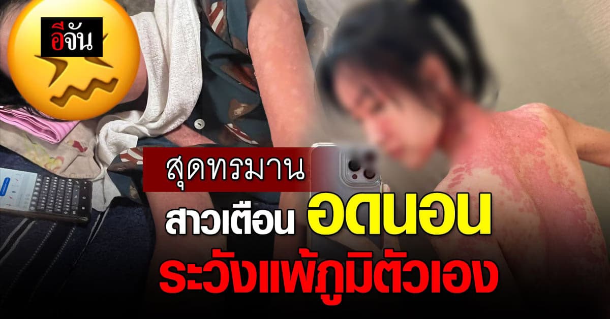 สาวเตือน ใครชอบอดนอน ระวังเป็นโรคแพ้ภูมิตัวเอง