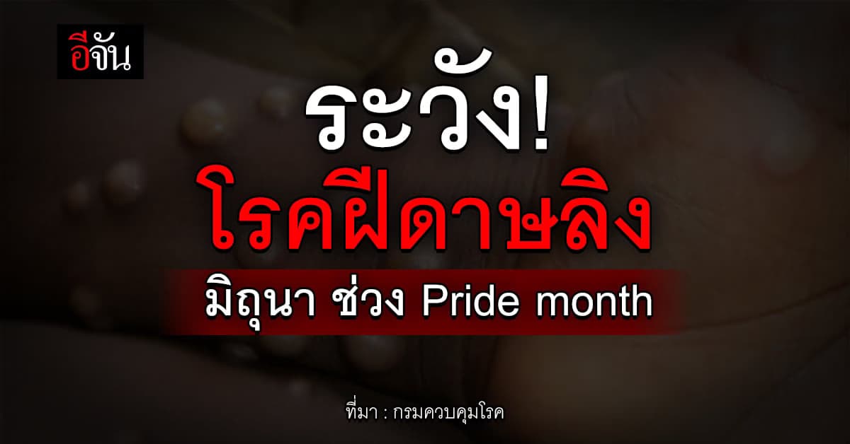 มิถุนา! ระวังโรคฝีดาษลิงระบาด เดือนแห่งความเท่าเทียม (Pride month)