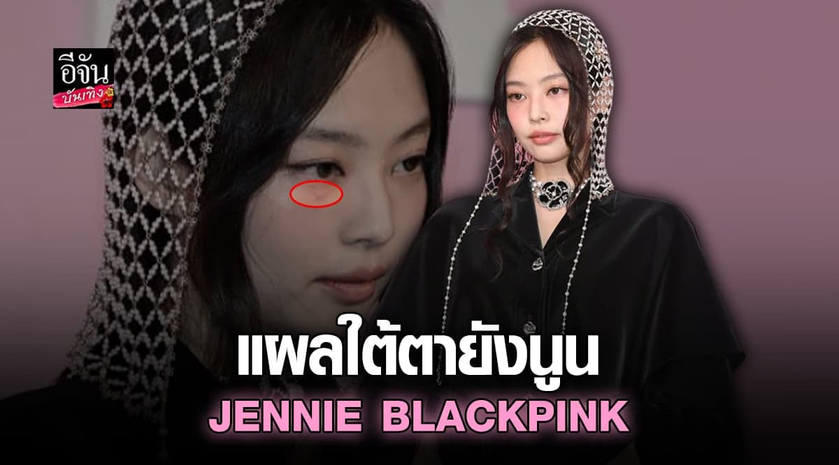 แฟนคลับเป็นห่วง เจนนี่ BLACKPINK แผลใต้ตายังนูนชัด