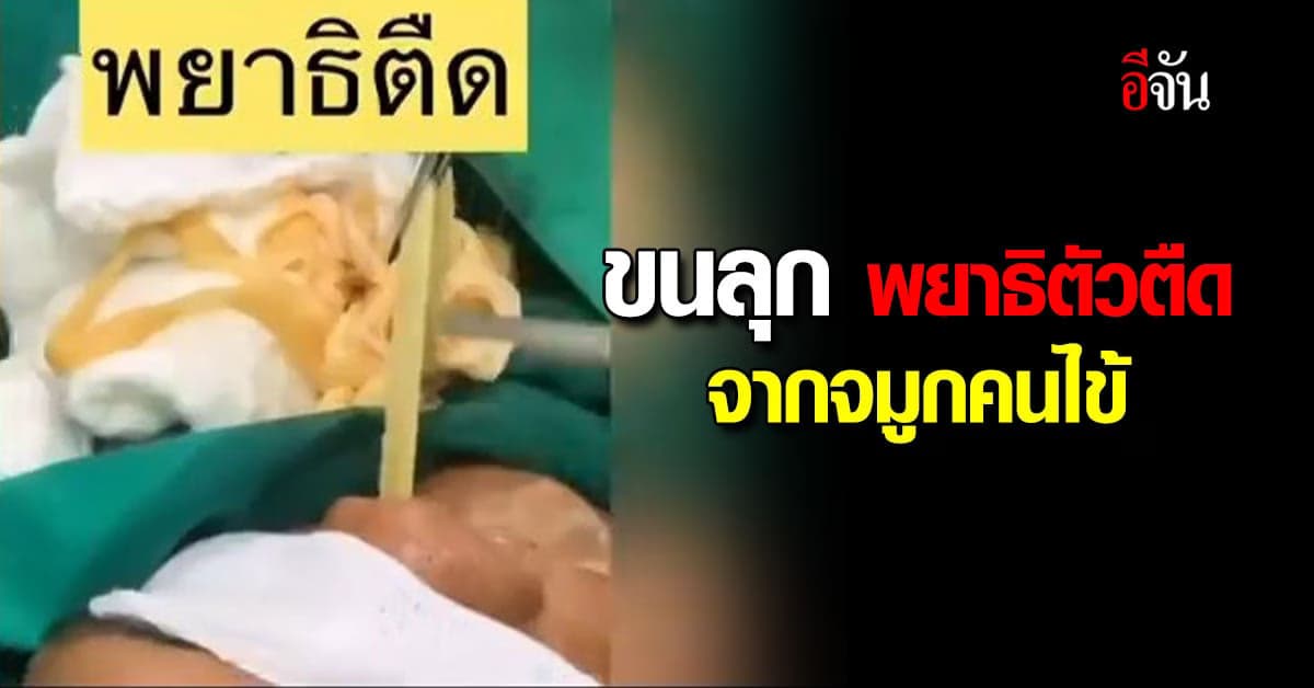 ขนลุก หมอดึงพยาธิตัวตืดยาวเฟื้อยออกจากจมูกคนไข้