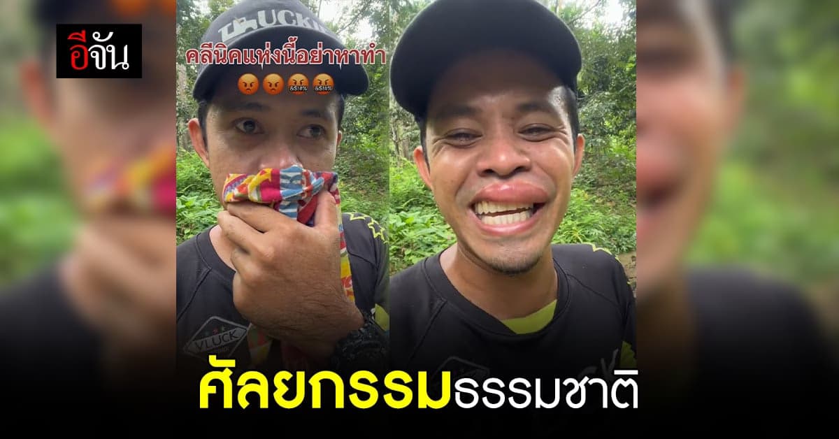 ขำไหล่สั่น หนุ่มศัลยกรรมปากกระจับธรรมชาติ จากตัวต่อ