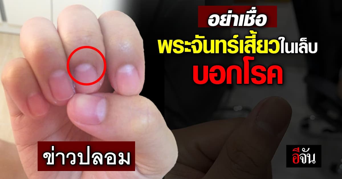 ข่าวปลอม!! พระจันทร์เสี้ยวในเล็บหาย เสี่ยงโรค