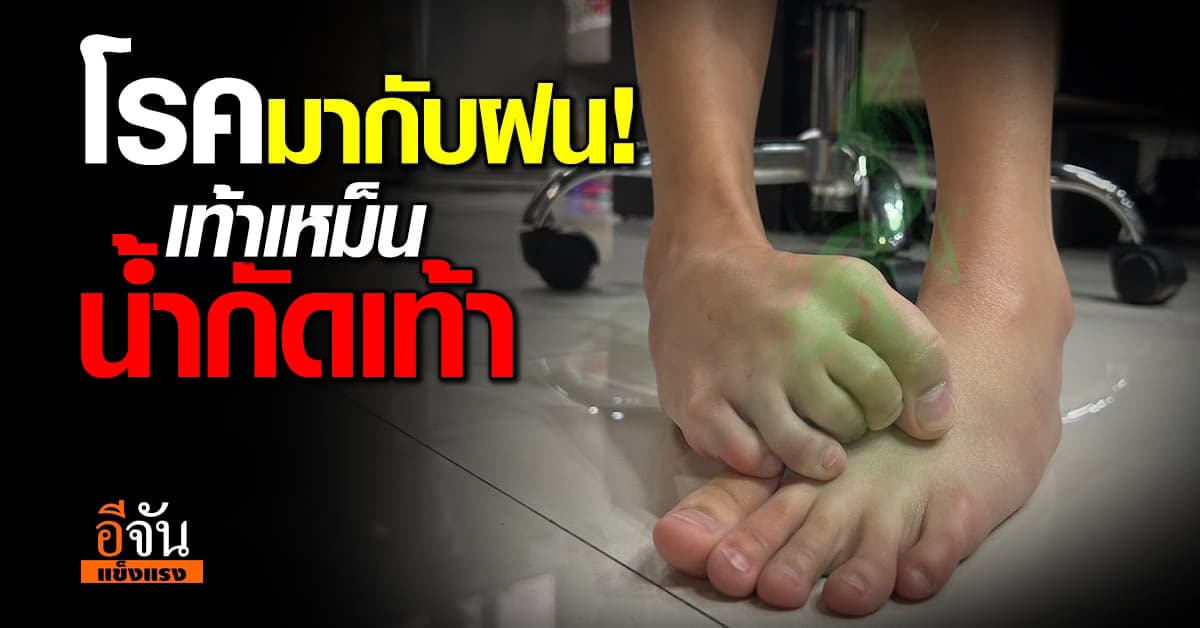 โรคผิวหนังหน้าฝน! เท้าเหม็น น้ำกัดเท้า กลาก เกลื้อน