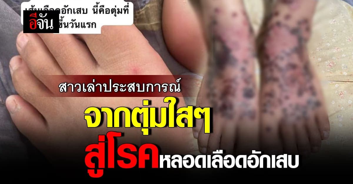 สาวแชร์อุทาหรณ์ จากตุ่มใสๆ ที่เท้า กลายเป็นโรคหลอดเลือดอักเสบ