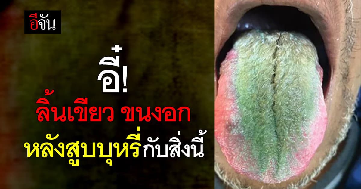 สิงห์อมควันต้องระวัง! ถ้าไม่อยากลิ้นเขียว มีขน