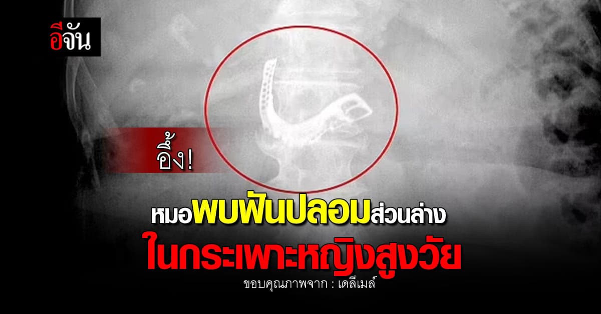 อึ้ง! หมอสหรัฐฯ พบฟันปลอมส่วนล่างในกระเพาะหญิงสูงวัย