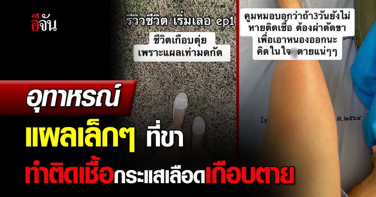 สาวแชร์อุทาหรณ์ ติดเชื้อในกระแสเลือด เกือบตายเพราะเป็นแผลที่ขา