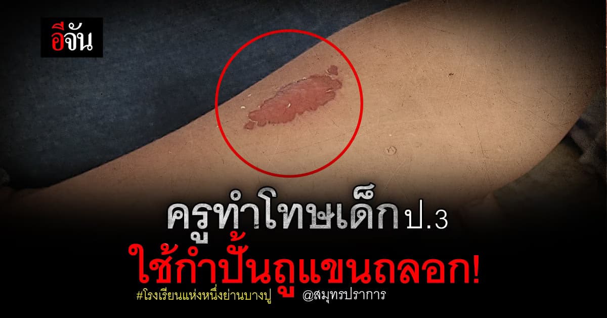 แม่ร้องสื่อ ครูทำโทษเด็กแขนเป็นแผล ตกดึกเด็กผวา นอนร้องไห้