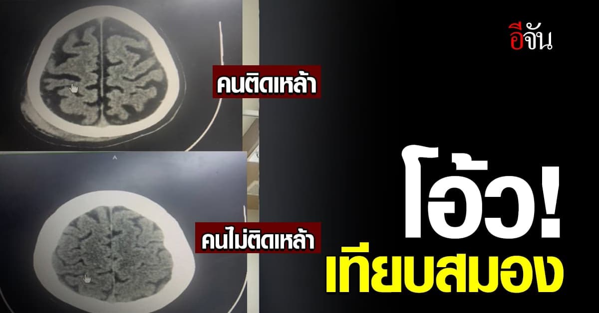 เทียบชัดๆ สมองคนติดเหล้า กับ คนไม่ติดเหล้า