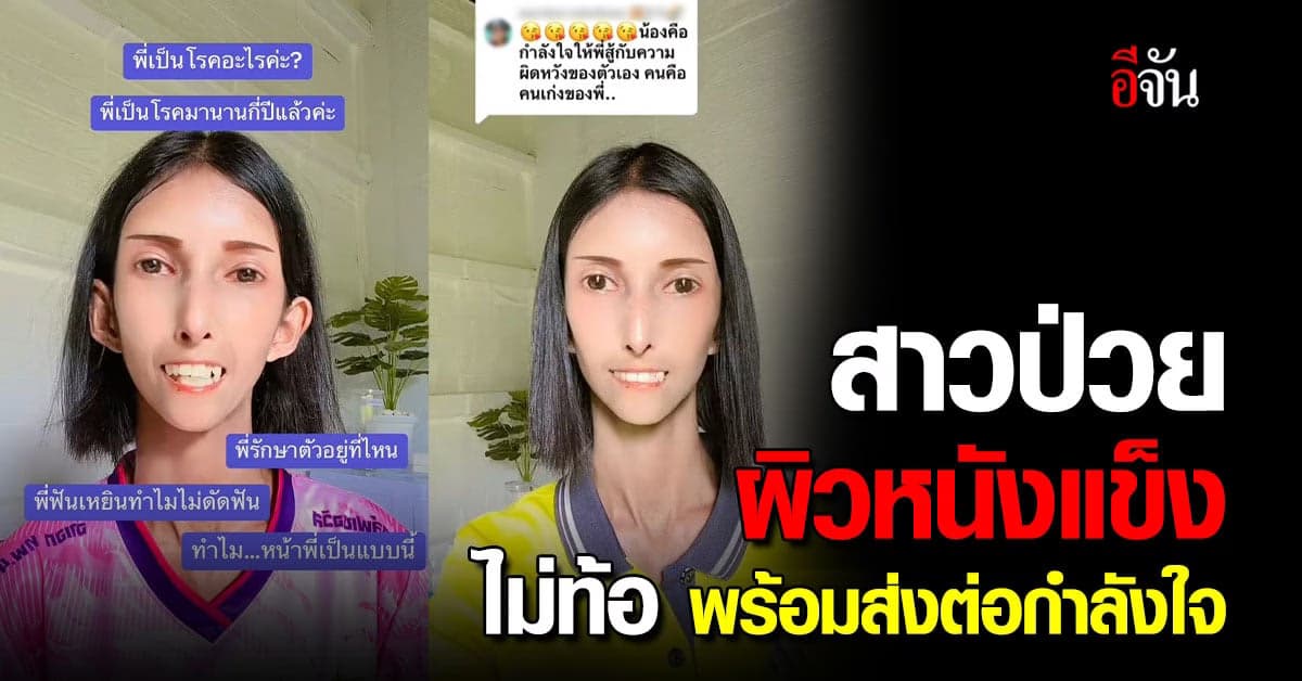 TikToker ป่วยโรคผิวหนังแข็ง ไม่ท้อ พร้อมส่งต่อกำลังใจ