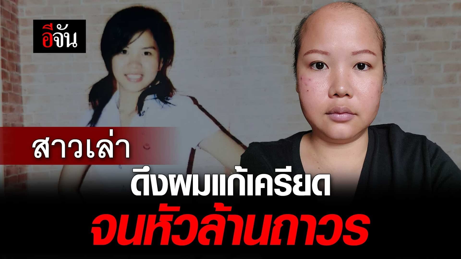 🎬 สาวเล่า ดึงผมแก้เครียด จนหัวล้านถาวร