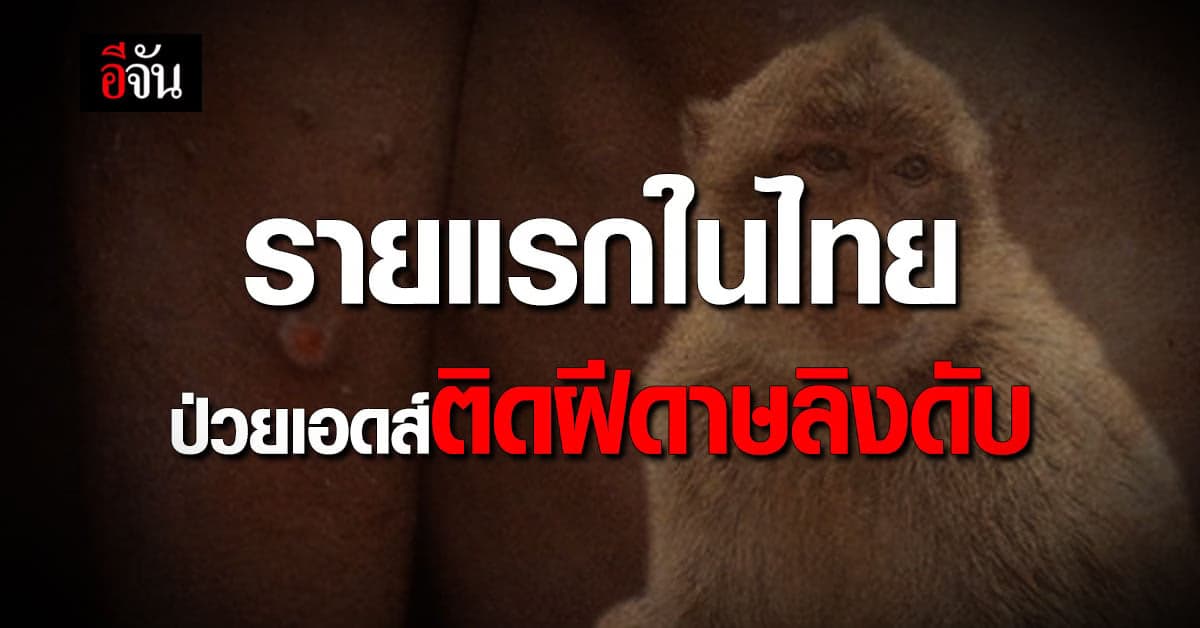 ระวัง! เสียชีวิตจากฝีดาษลิงรายแรกในไทย เกือบครึ่งเป็นผู้ป่วยเอดส์