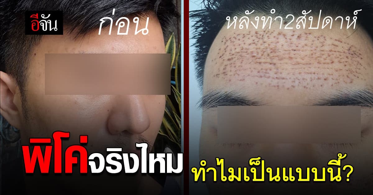 หนุ่มแชร์อุทาหรณ์ ทำพิโค้คลินิกดังกลาเมือง ผลรับสุดเจ็บใจ