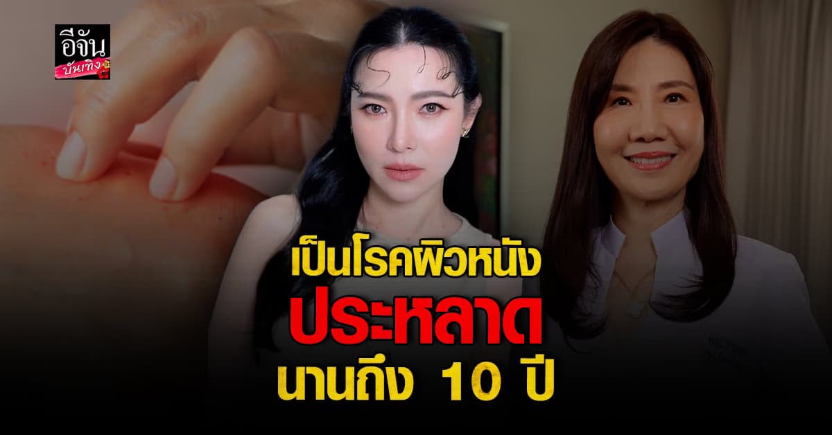 ต้นหอม ศกุนตลา เผยเป็นโรคผิวหนังประหลาด นาน 10 ปี