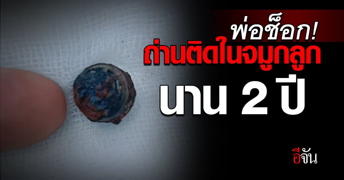พ่อช็อก! ถ่านของเล่นติดในจมูกลูกนานถึง 2 ปี