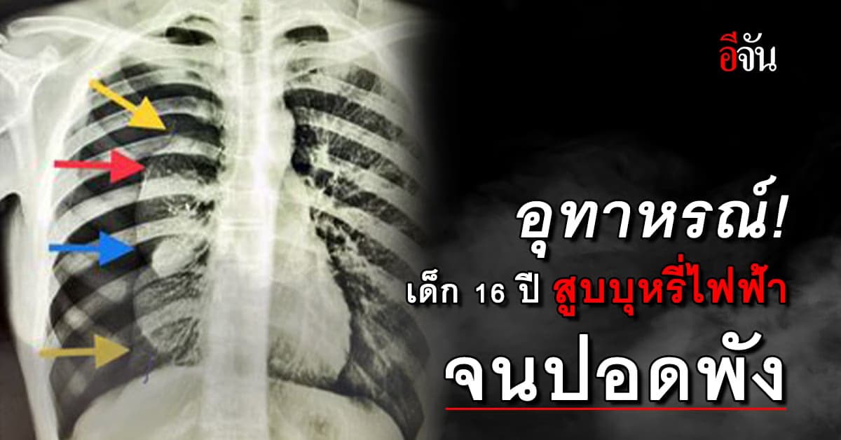 อุทาหรณ์! เด็ก 16 ปี สูบบุหรี่ไฟฟ้าจนปอดพัง