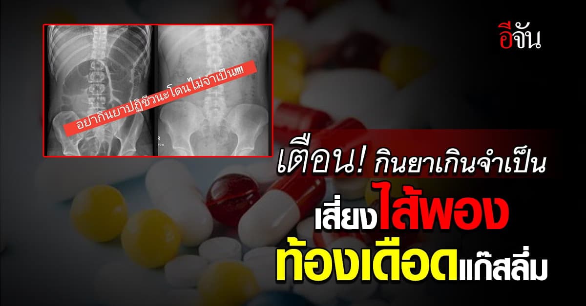 หมอเตือน! อย่ากินยาปฏิชีวนะ โดยไม่จำเป็น เสี่ยงไส้พอง แก๊สลึ่ม