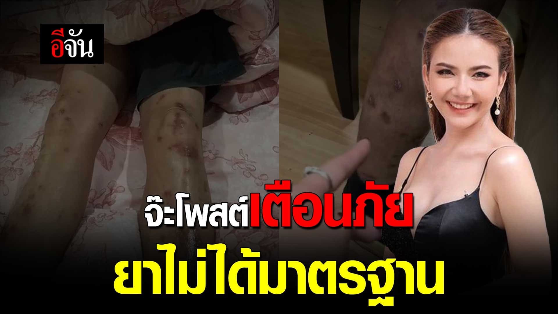 🎬 จ๊ะ นงผณี โพสต์เตือนภัย ยาไม่ได้มาตรฐาน