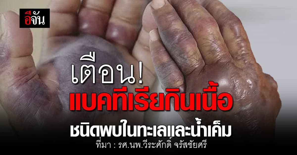 เตือน! แบคทีเรียกินเนื้อพบในทะเลและน้ำเค็ม