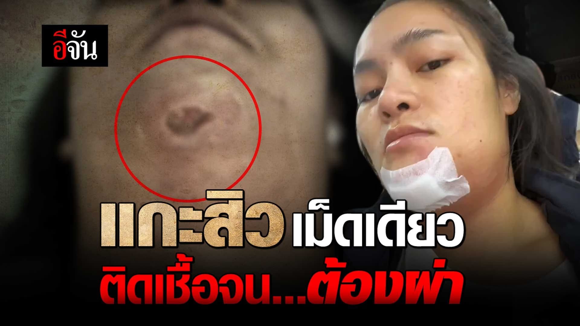 🎬 แกะสิว เม็ดเดียว ติดเชื้อจนต้องผ่า