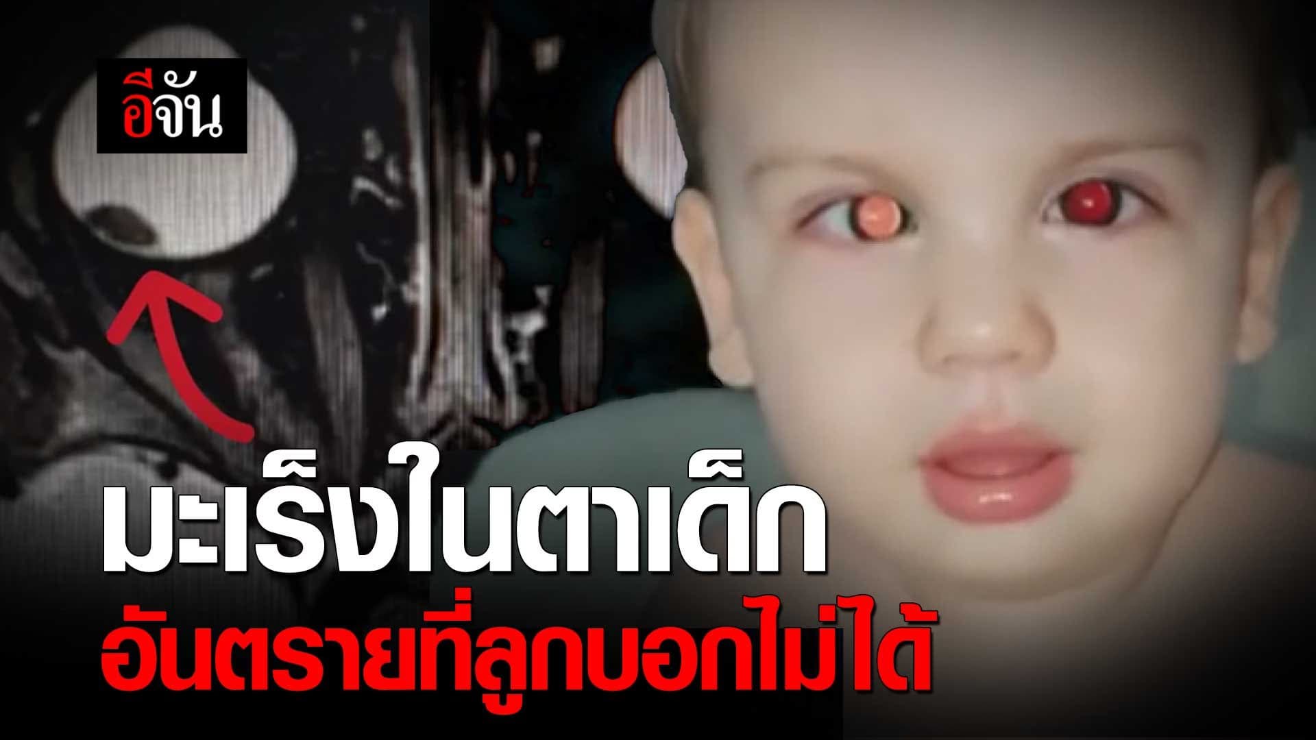 🎬 มะเร็งในตาเด็ก อันตรายที่ลูกบอกไม่ได้