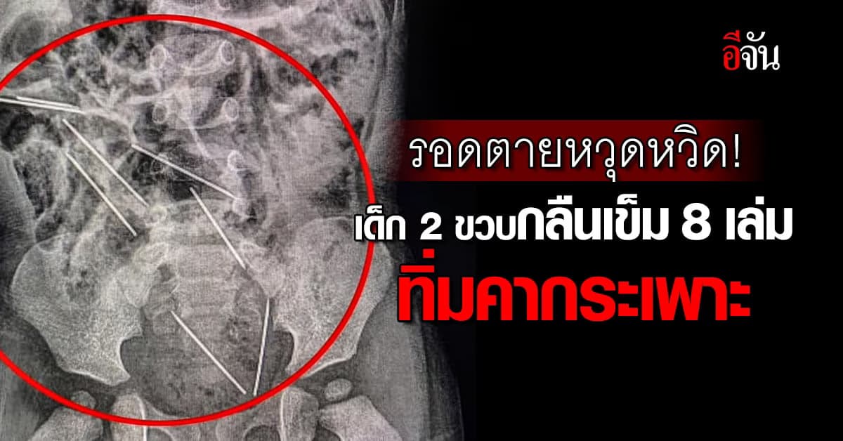 อุทาหรณ์พ่อแม่! เด็ก 2 ขวบรอดตายหวุดหวิด หลังกลืนเข็มเข้าไป 8 เล่ม