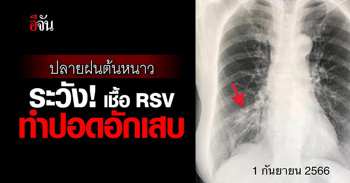 ปลายฝนต้นหนาว ระวัง! เชื้อ RSV ทำปอดอักเสบ