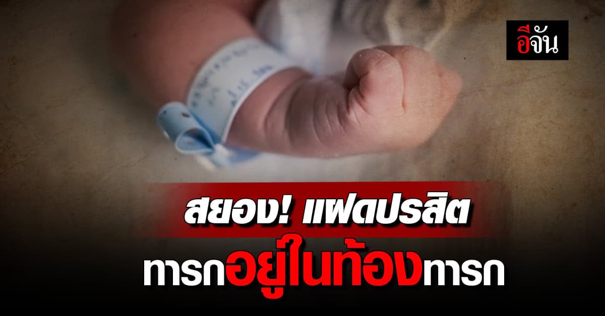 สยอง! แพทย์พบ ‘แฝดปรสิต’ ทารกในท้องทารก 10 เดือน