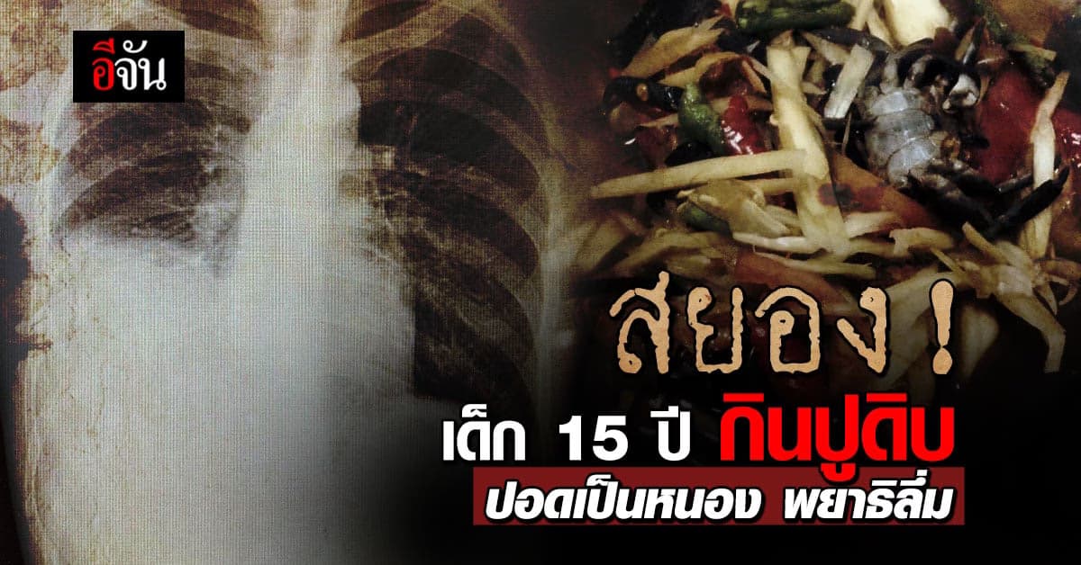 สยอง! เด็ก 15 ปี กินปูดิบ พยาธิขึ้นปอดจนเกิดโพรงฝีหนอง