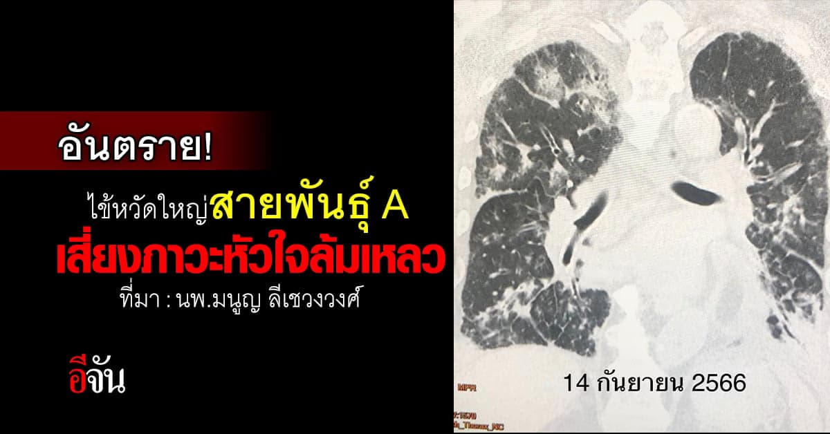 หมอมนูญ เตือน ไข้หวัดใหญ่สายพันธุ์ A เสี่ยงภาวะหัวใจล้มเหลว