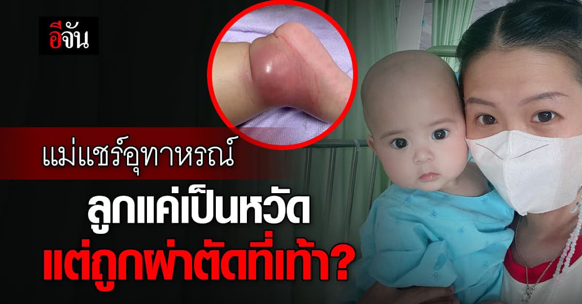 แม่แชร์อุทาหรณ์ ลูกป่วยเป็นไข้หวัด แต่เชื้อลามไปที่เท้าจนต้องผ่าตัด