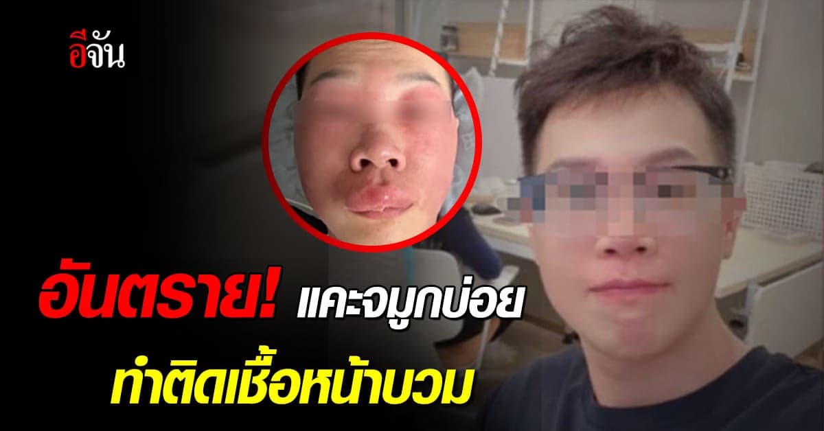 อันตราย! หนุ่มจีนแคะจมูกบ่อยทำติดเชื้อหน้าบวม
