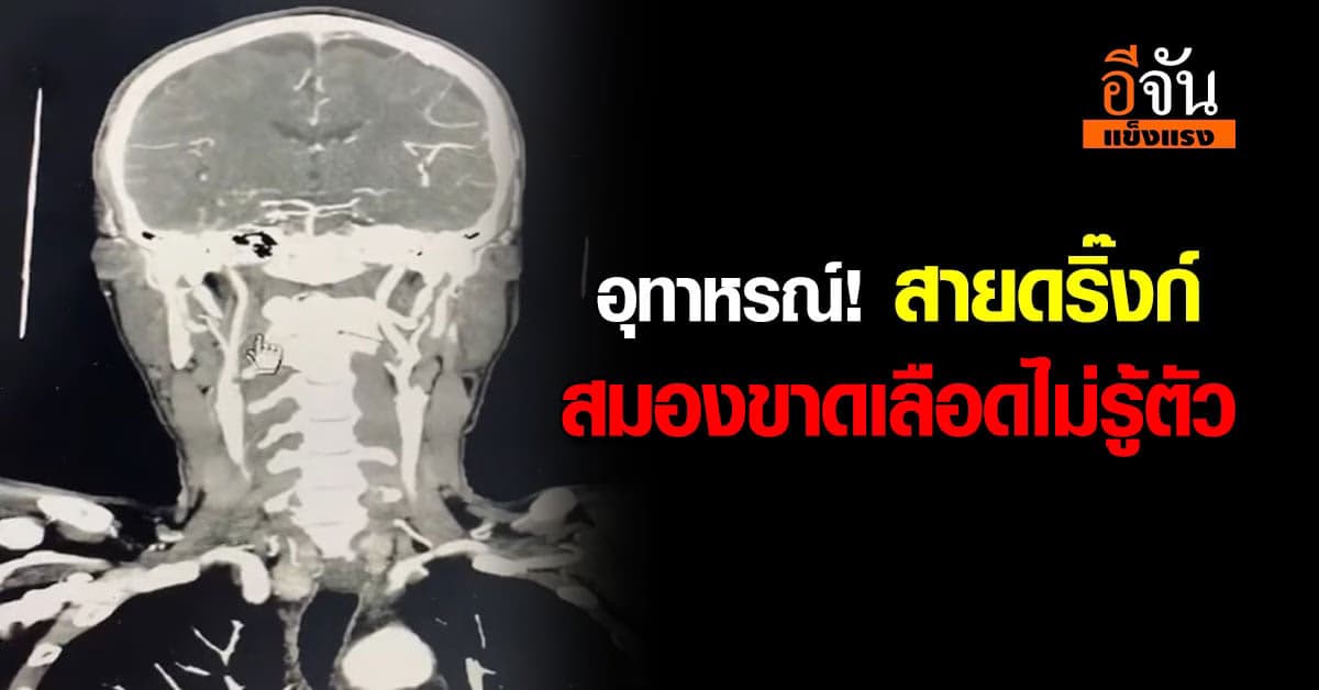 อุทาหรณ์! สายดริ๊งก์ สมองขาดเลือดไม่รู้ตัว