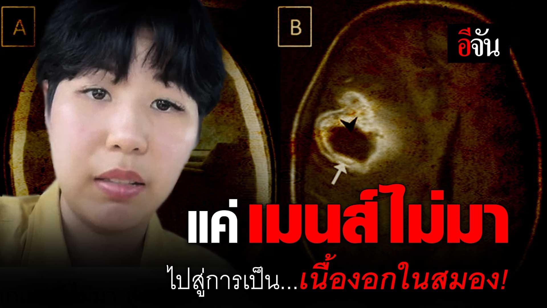 🎬 คลิปโซเชียล เมนส์ไม่มา ไปสู่การเป็น เนื้องอกต่อมใต้สมอง!