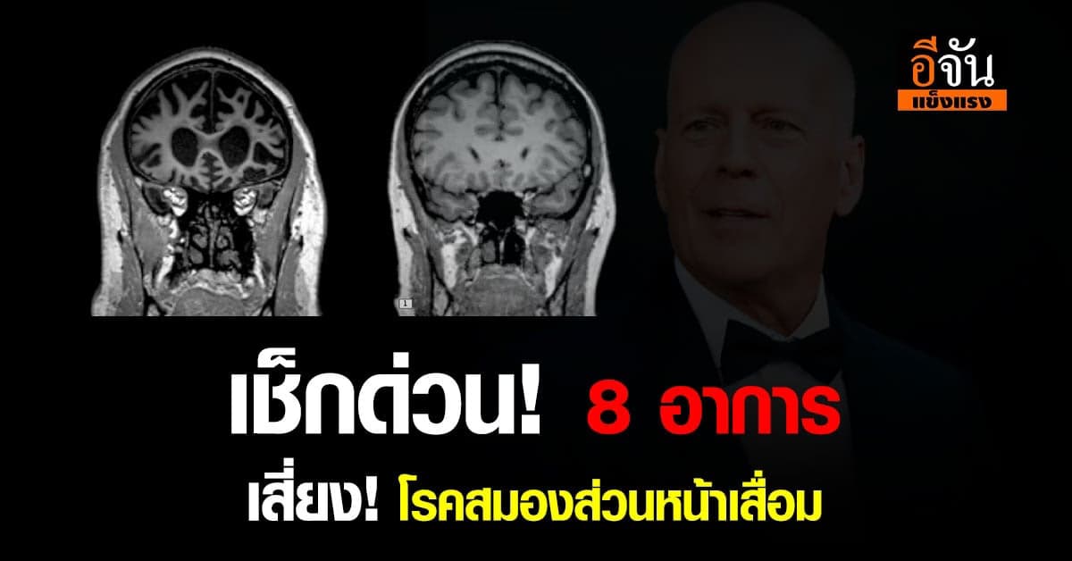โรคสมองส่วนหน้าเสื่อม ทุกคนก็มีโอกาสเป็น!