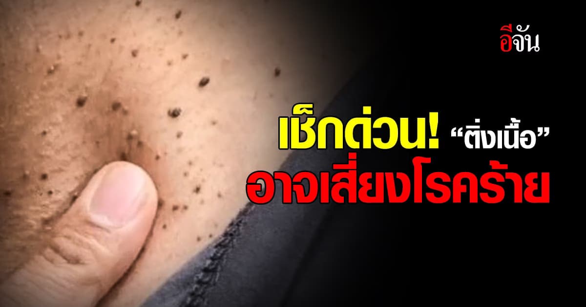 แพทย์เตือน! ติ่งเนื้อที่คอ อาจเป็นสัญญาณของโรคร้าย