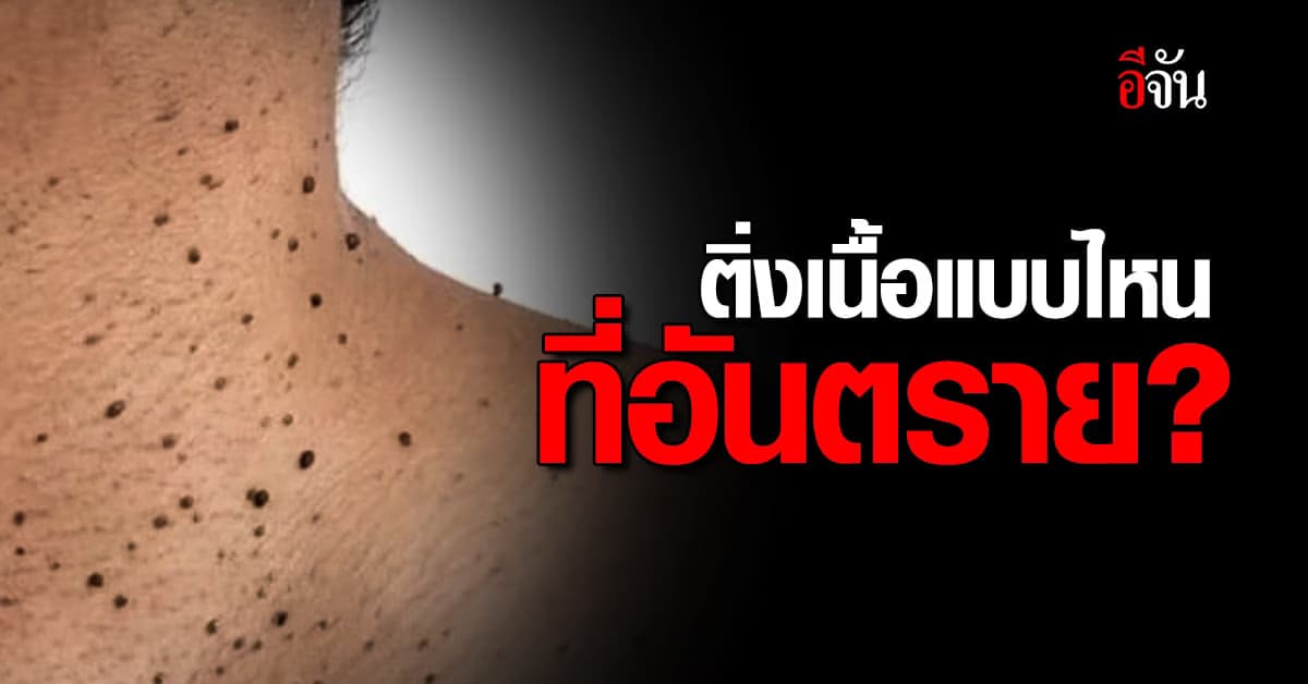 ศูนย์ต้านเฟคนิวส์ เช็กแล้ว ติ่งเนื้อแบบไหนที่อันตราย?