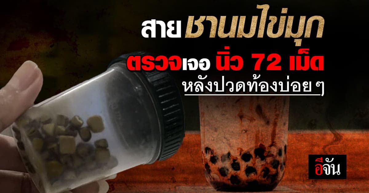 อุทาหรณ์! ปวดท้องบ่อยๆ เจอนิ่ว 72 เม็ด คาดเพราะดื่มชานมไข่มุก