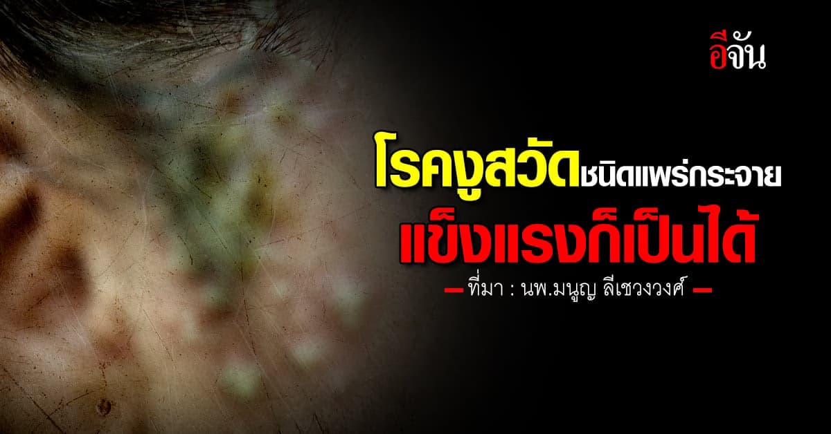 โรคงูสวัด ชนิดแพร่กระจาย แข็งแรงก็เป็นได้ พบน้อยแต่พบนะ