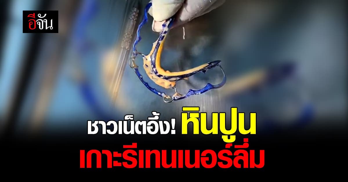 ขนลุก! หินปูนเกาะรีเทนเนอร์ลึ่ม “ทำความสะอาดด้วยนะ ถือว่าหมอขอ”