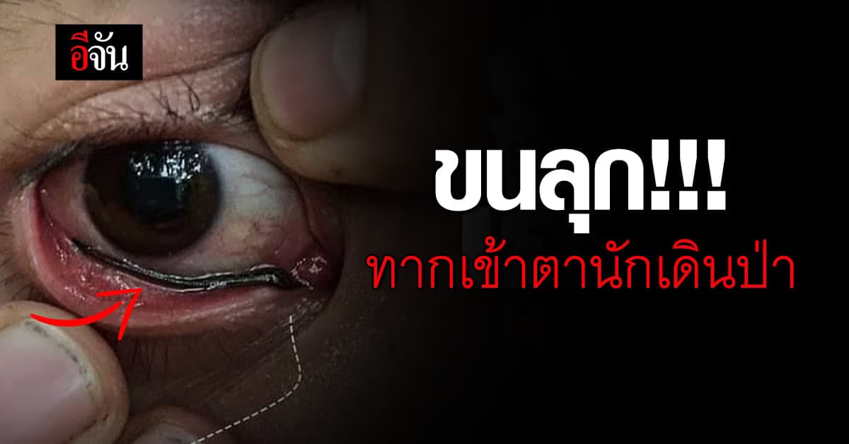 เรื่องสยองของนักเดินป่า ทากเข้าตา มันเกิดขึ้นได้!