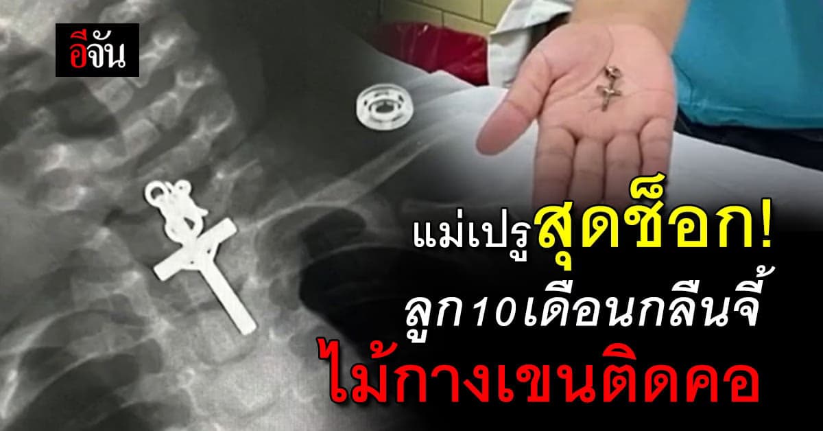 แม่สุดช็อก! ลูก 10 เดือนกลืนจี้ไม้กางเขนติดอยู่ในหลอดอาหาร