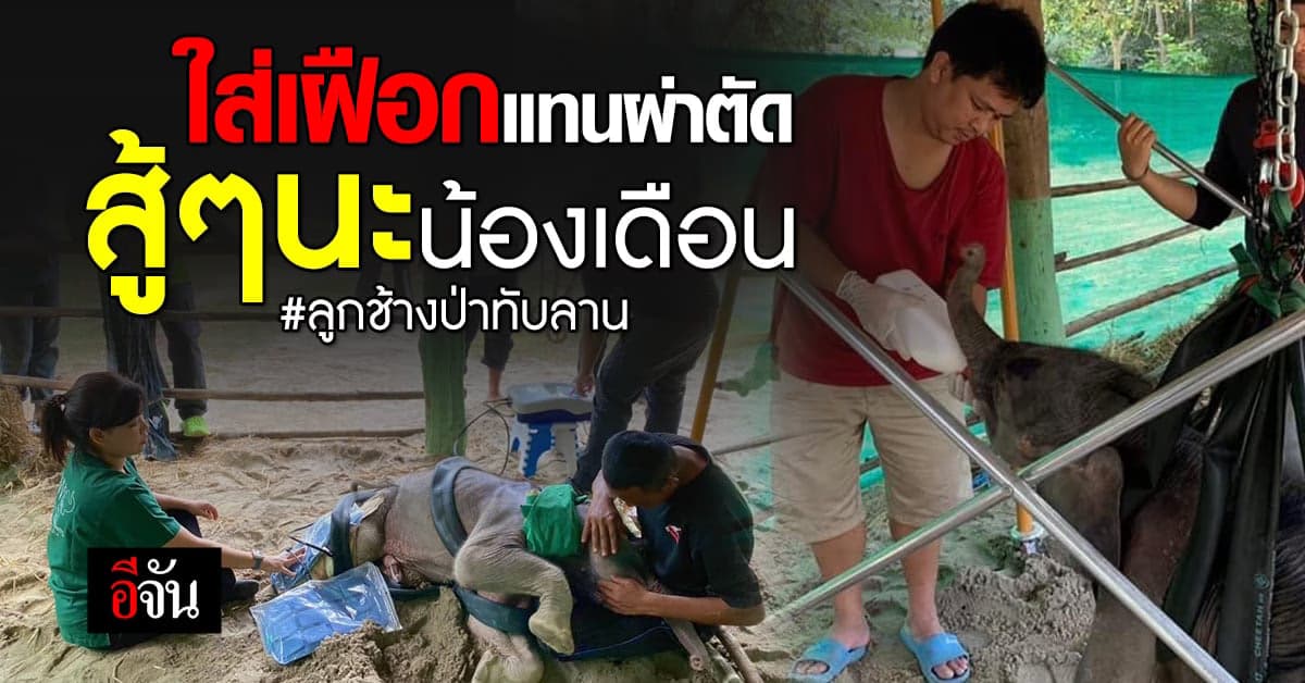 ปรับแผนรักษาน้องเดือน ไม่ผ่าตัด แต่ใส่เฝือกแทน