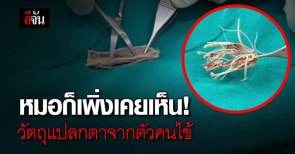 หมออึ้ง! เจอวัตถุแปลกตา จากคนไข้ชาวฮ่องกง มันเยอะมาก