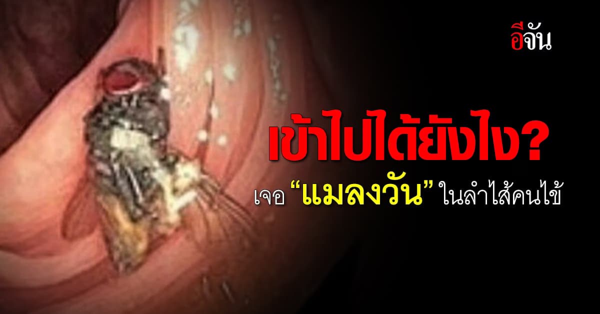 อึ้ง! เข้าไปได้ยังไง หมอส่องกล้องเจอ “แมลงวัน” ในลำไส้คนไข้