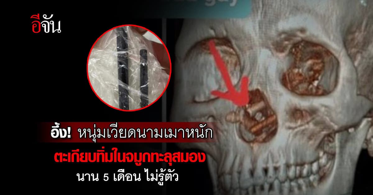 หมอยังช็อก! หนุ่มเวียดนามเมาหนักตะเกียบทิ่มในจมูกทะลุสมองนาน 5 เดือน