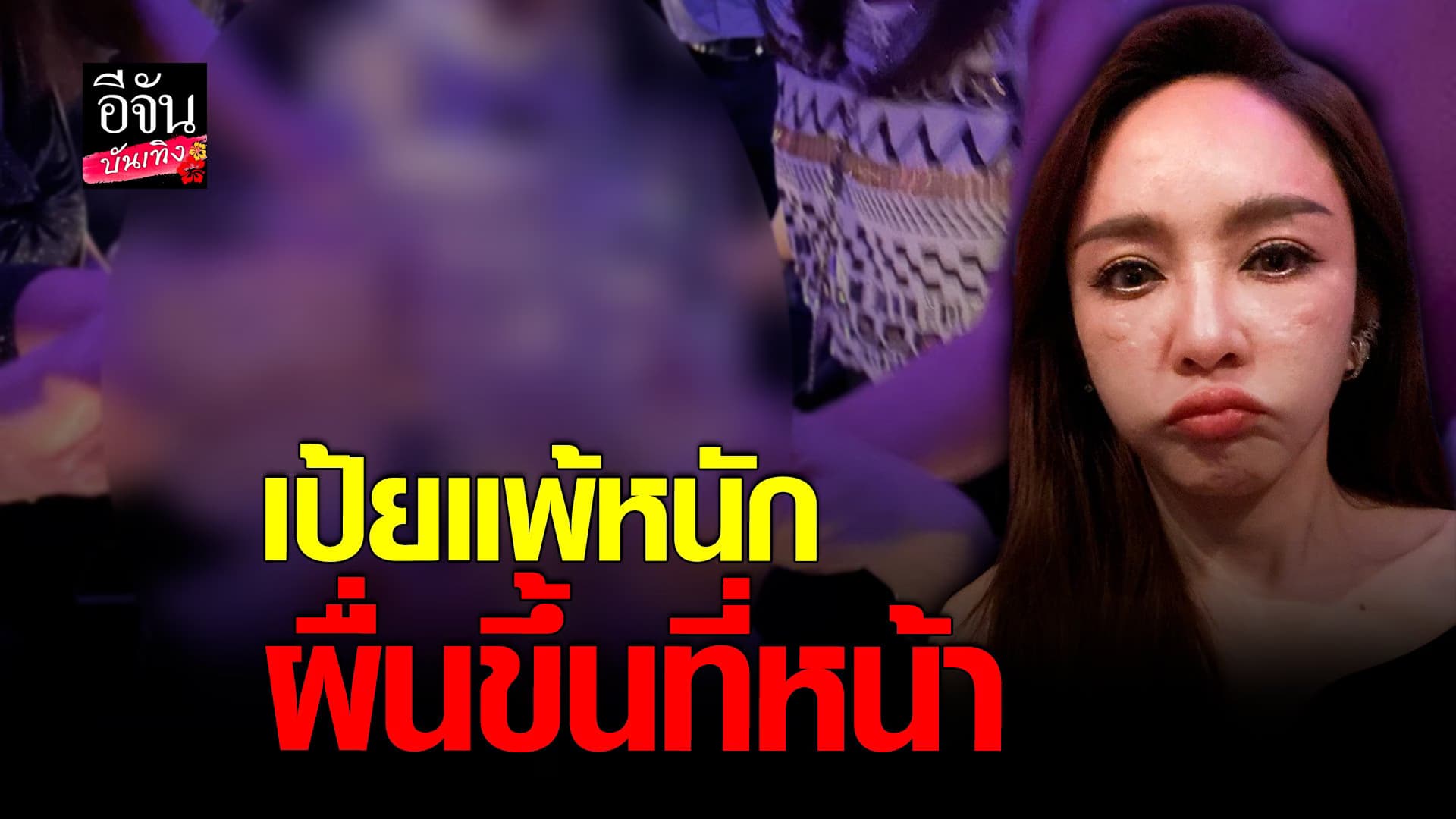 🎬 คลิปบันเทิง : เป้ย กำลังสนุก อยู่ๆ แพ้แอลกอฮอล์หนัก ผื่นขึ้นที่หน้า