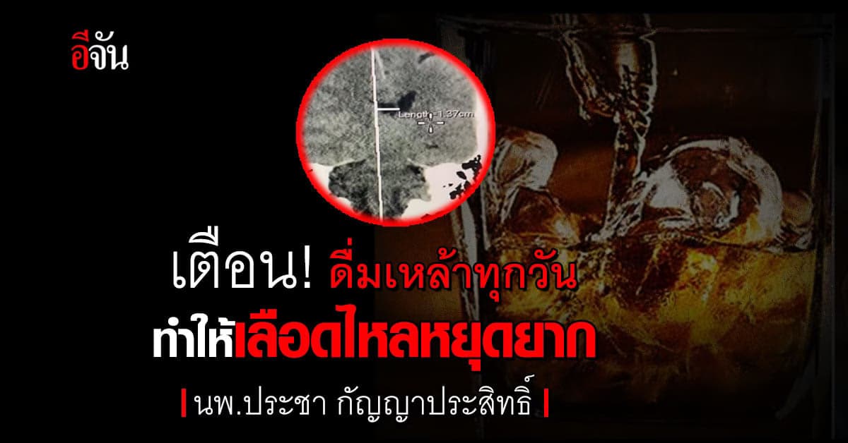 เตือน! ดื่มเหล้าทุกวันทำให้เลือดไหลหยุดยาก