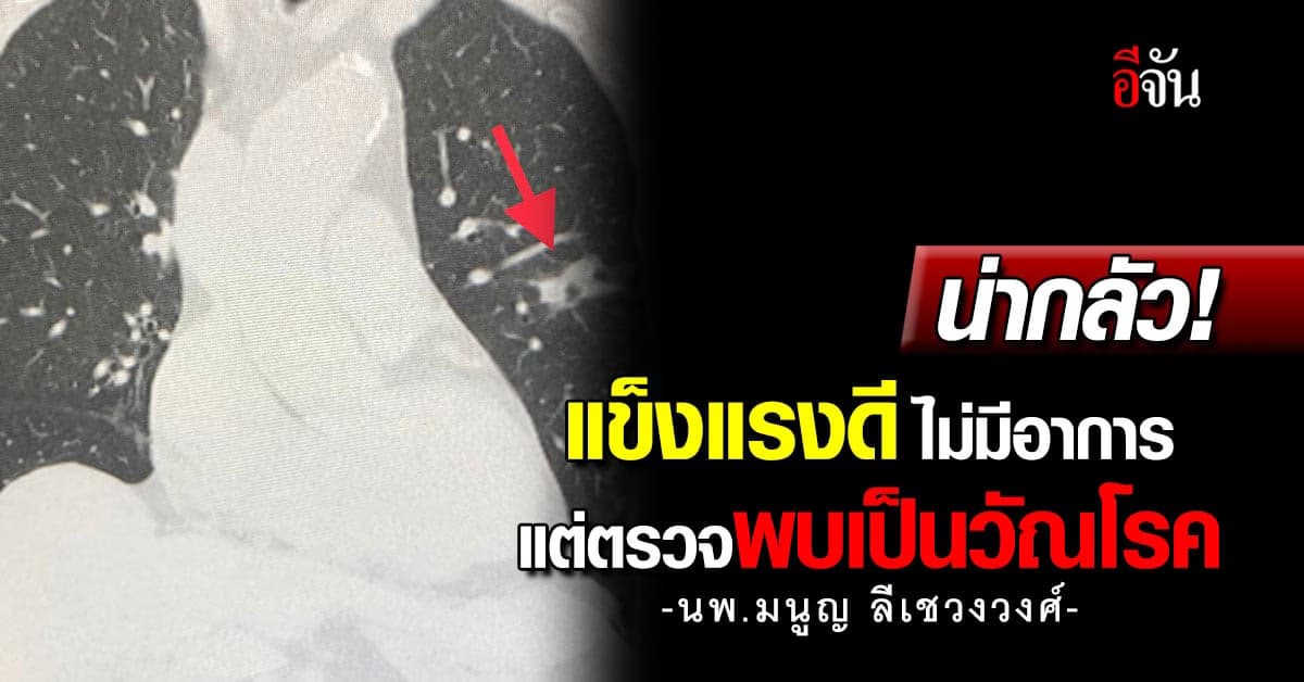 น่ากลัว! นพ.มนูญ ยกเคสคนไข้แข็งแรงดีไม่มีอาการ แต่ตรวจพบเป็นวัณโรค